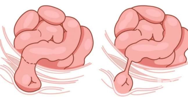 青海东大肛肠医院：疝气是什么？有什么危害？