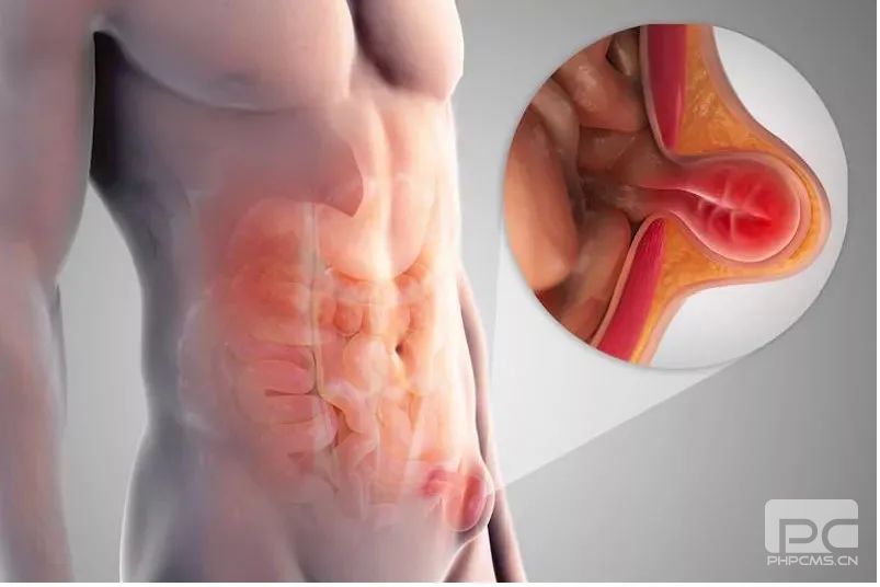 青海东大肛肠医院：人为什么会出现疝气？怎么治疗？
