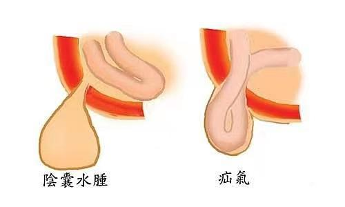 青海东大肛肠医院：什么是鞘膜积液