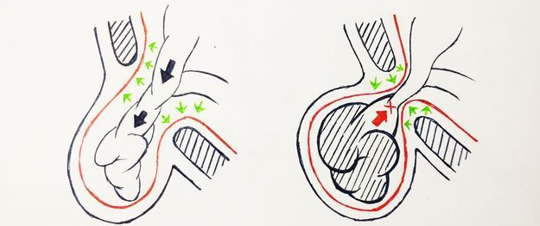 青海东大肛肠医院：疝气，疝的不是“气”，卡住要命