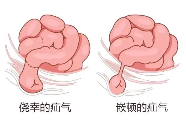 青海东大肛肠医院：得了疝气怎么办？