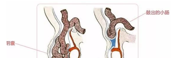 青海东大肛肠医院：小儿疝气的危害有哪些？