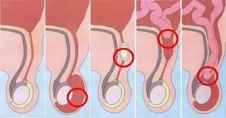 青海东大肛肠医院：疝气对身体的危害有多大？