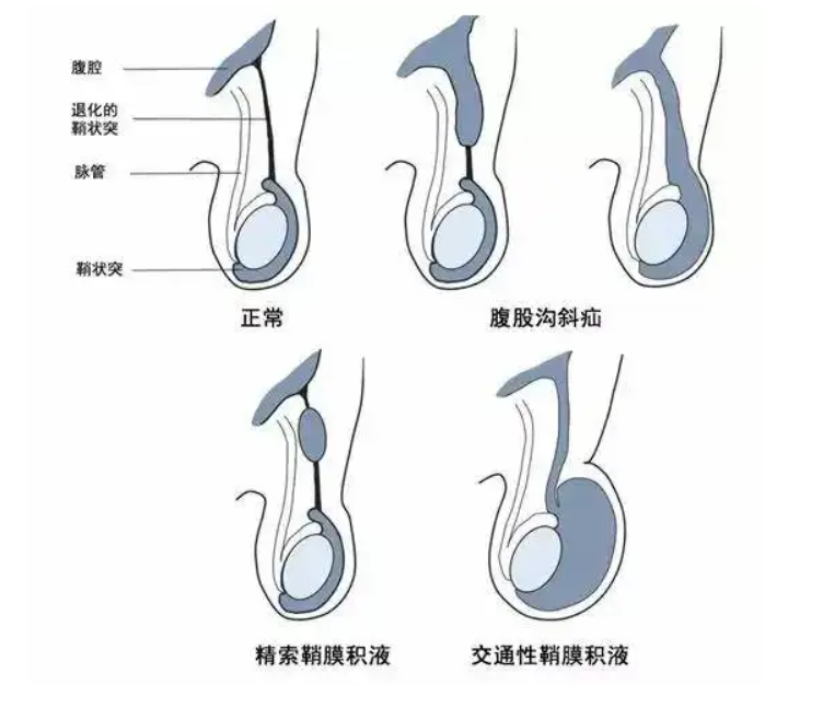 青海东大肛肠医院：小儿疝气有哪些原因？